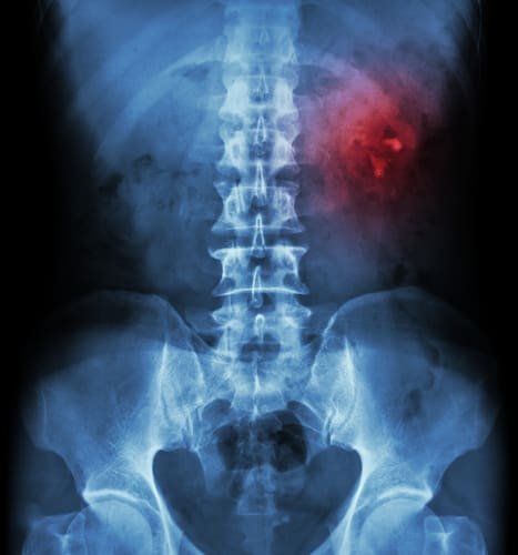 Xray of a human body showing stone in a right Kidney